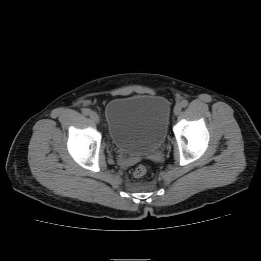 File:Obstructed kidney with perinephric urinoma (Radiopaedia 26889-27066 Axial non-contrast 61).jpg