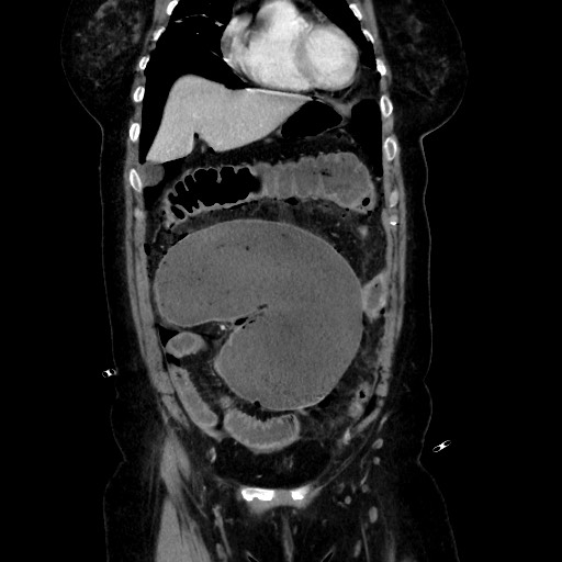 Obstructive distal colonic adenocarcinoma causing cecal perforation (Radiopaedia 86830-102989 C 67).jpg