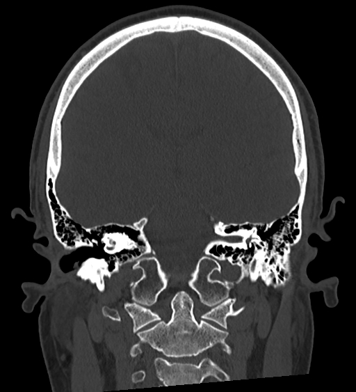 Occipital spur and Currarino type A atlas anomaly (Radiopaedia 87027-103285 Coronal bone window 89).jpg