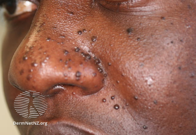 File:Unilateral angiofibromas on the nose and face of a black skinned male. (DermNet NZ facial-angiofibromas-18).jpg