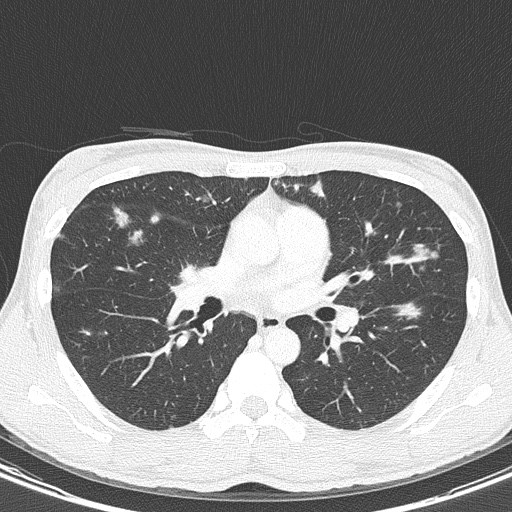 AIDS-related Kaposi sarcoma (Radiopaedia 85247-100811 Axial lung window 81).jpg