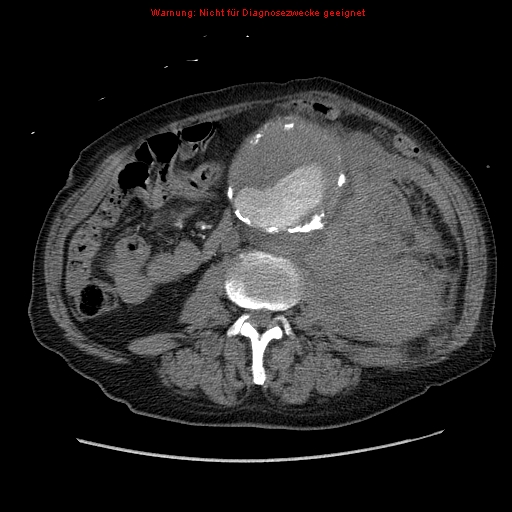 Abdominal aortic aneurysm- extremely large, ruptured (Radiopaedia 19882-19921 Axial C+ arterial phase 39).jpg