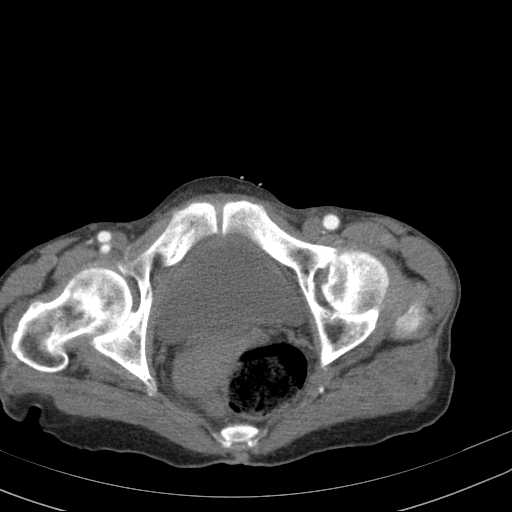 File:Abdominal aortic aneurysm (Radiopaedia 20827-20742 Axial C+ arterial phase 38).jpg
