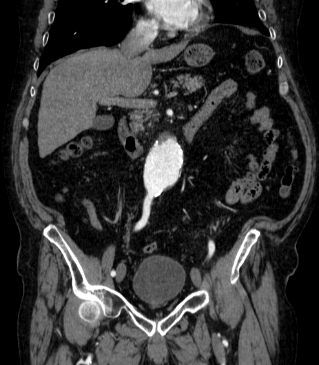 Abdominal aortic aneurysm (Radiopaedia 25855-26001 Coronal C+ arterial phase 24).jpg