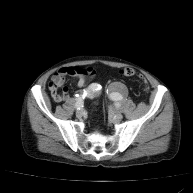 Abdominal aortic aneurysm (Radiopaedia 29248-29660 Axial C+ portal venous phase 47).jpg