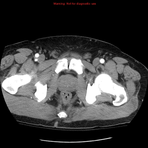 Abdominal aortic aneurysm (Radiopaedia 8190-9038 Axial C+ arterial phase 84).jpg