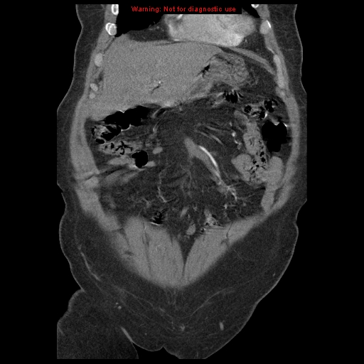 Abdominal aortic aneurysm (Radiopaedia 8190-9038 Coronal C+ arterial phase 28).jpg