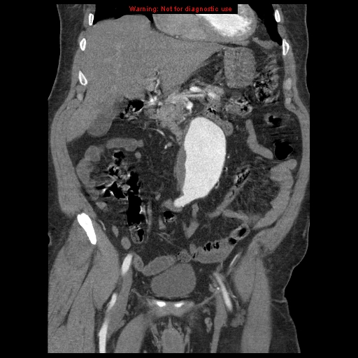 Abdominal aortic aneurysm (Radiopaedia 8190-9038 Coronal C+ arterial phase 46).jpg