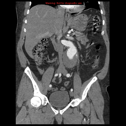 Abdominal aortic aneurysm (Radiopaedia 8190-9038 Coronal C+ arterial phase 63).jpg