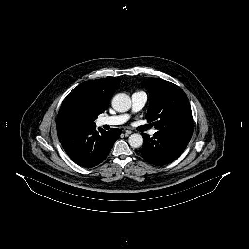 Abdominal aortic aneurysm (Radiopaedia 83094-97462 Axial renal cortical phase 38).jpg