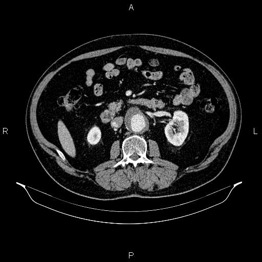 Abdominal aortic aneurysm (Radiopaedia 83094-97462 Axial renal cortical phase 94).jpg
