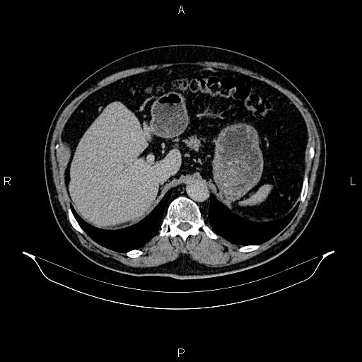 Abdominal aortic aneurysm (Radiopaedia 83094-97462 Axial renal excretory phase 30).jpg