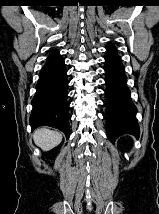 Abdominal aortic aneurysm (Radiopaedia 83094-97462 Coronal renal cortical phase 78).jpg