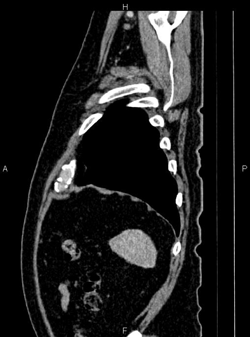 Abdominal aortic aneurysm (Radiopaedia 83094-97462 Sagittal renal cortical phase 108).jpg