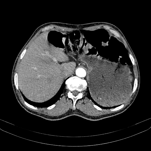 Abdominal aortic aneurysm (Radiopaedia 83581-98689 Axial C+ arterial phase 28).jpg