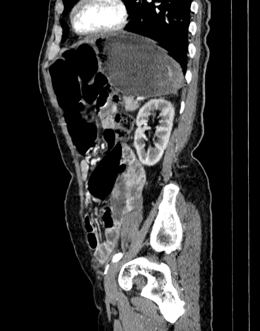 Abdominal aortic aneurysm (Radiopaedia 83581-98689 Sagittal C+ arterial phase 89).jpg