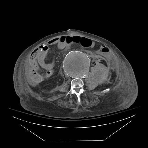 Abdominal aortic aneurysm - impending rupture (Radiopaedia 19233-19247 Axial non-contrast 100).jpg