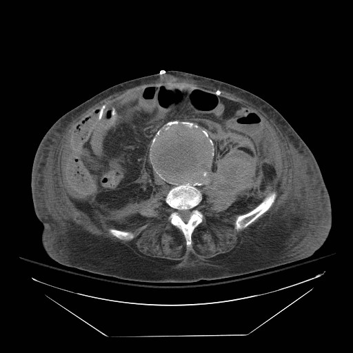 Abdominal aortic aneurysm - impending rupture (Radiopaedia 19233-19247 Axial non-contrast 103).jpg