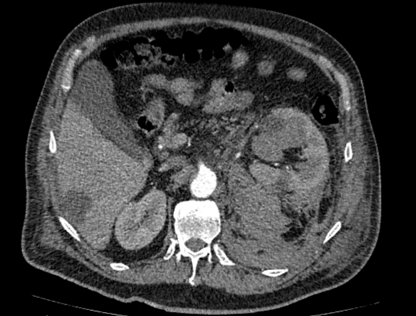 Abdominal aortic aneurysm rupture (Radiopaedia 54179-60362 Axial C+ arterial phase 26).jpg