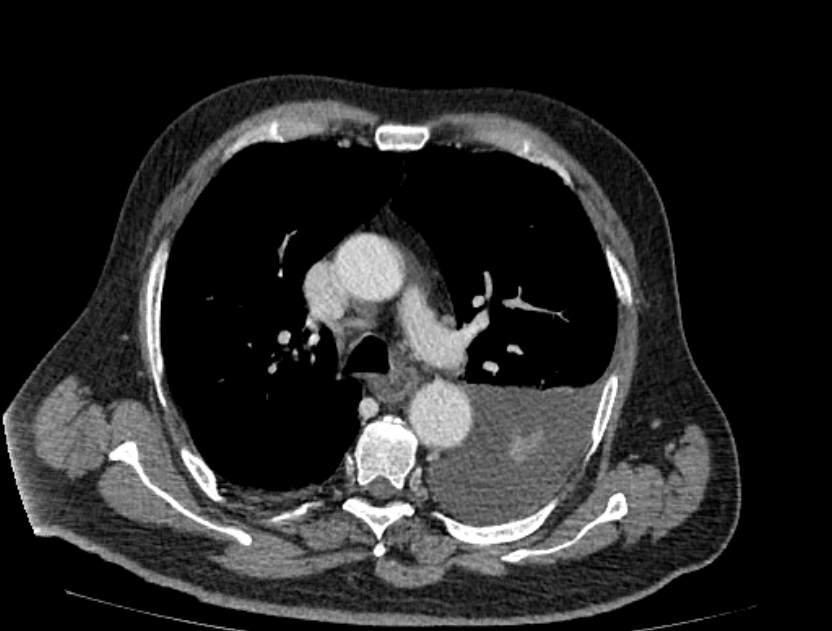 Abdominal aortic aneurysm rupture (Radiopaedia 54179-60362 Axial C+ portal venous phase 46).jpg
