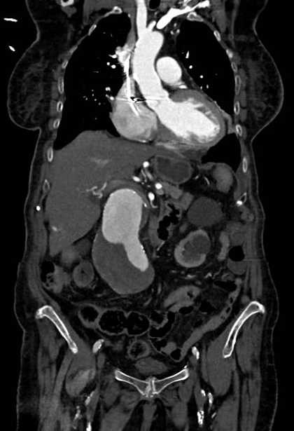 Abdominal aortic aneurysm with thrombus fissuration (Radiopaedia 73192-83919 Coronal C+ arterial phase 27).jpg