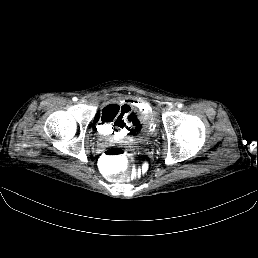 File:Abdominal collection due to previous cecal perforation (Radiopaedia 80831-94320 Axial C+ portal venous phase 190).jpg