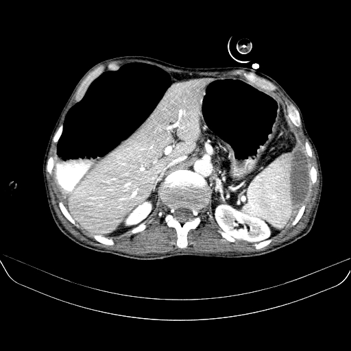 File:Abdominal collection due to previous cecal perforation (Radiopaedia 80831-94320 Axial C+ portal venous phase 53).jpg