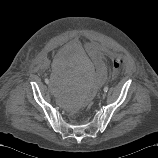 Abdominal hematoma (Radiopaedia 33614-34715 Axial C+ portal venous phase 106).png