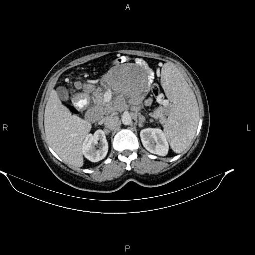 File:Abdominal lymphoma with sandwich sign (Radiopaedia 84378-99704 Axial C+ portal venous phase 20).jpg