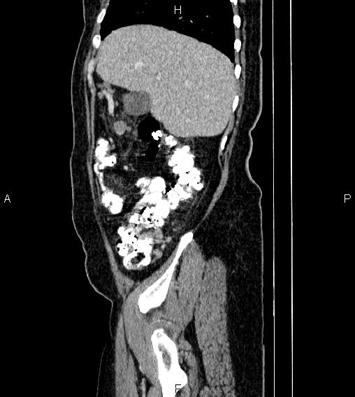 Abdominal lymphoma with sandwich sign (Radiopaedia 84378-99704 Sagittal C+ portal venous phase 13).jpg
