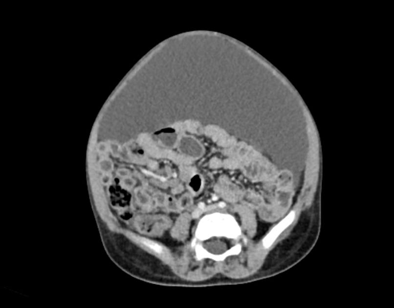 Abdominal premesenteric cystic lymphangioma (Radiopaedia 82995-97350 Axial C+ portal venous phase 41).jpg