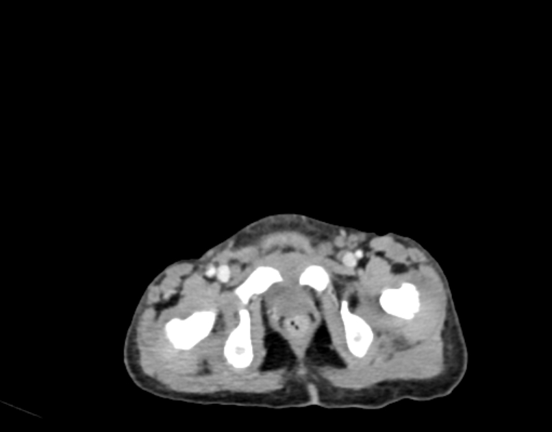Abdominal premesenteric cystic lymphangioma (Radiopaedia 82995-97350 Axial C+ portal venous phase 68).jpg