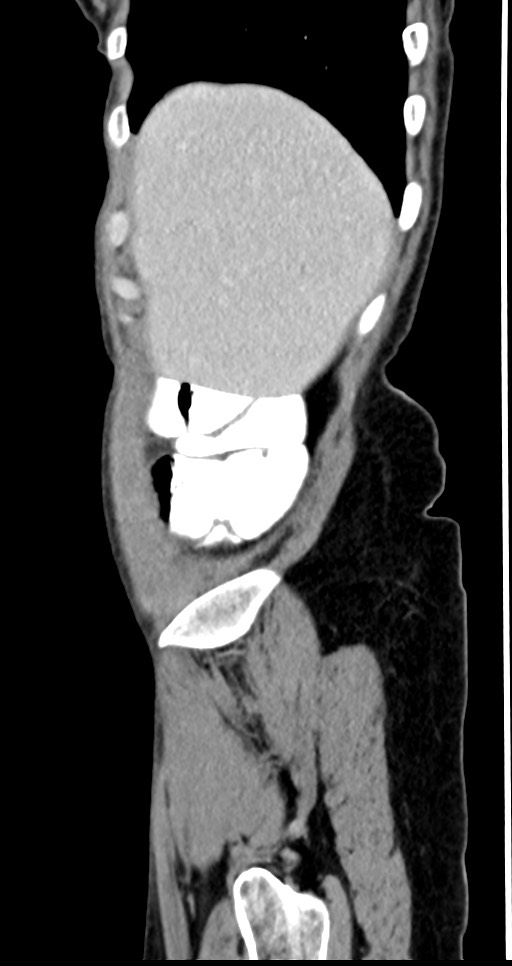 Abdominal wall and retroperitoneal tuberculosis (Radiopaedia 88137-104729 Sagittal C+ portal venous phase 130).jpg