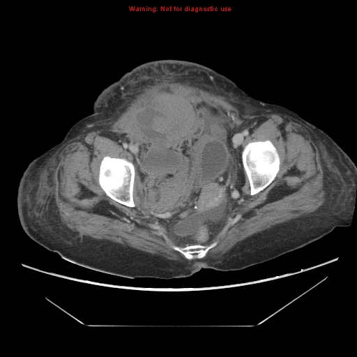 File:Abdominal wall hematoma (Radiopaedia 9427-10112 Axial C+ portal venous phase 97).jpg