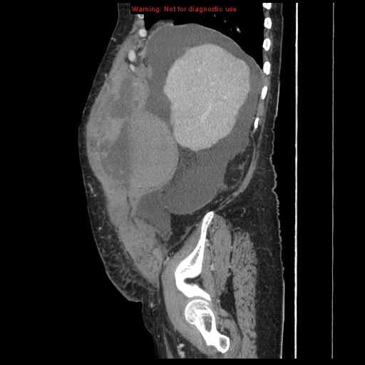 Abdominal wall hematoma (Radiopaedia 9427-10112 Sagittal C+ portal venous phase 85).jpg