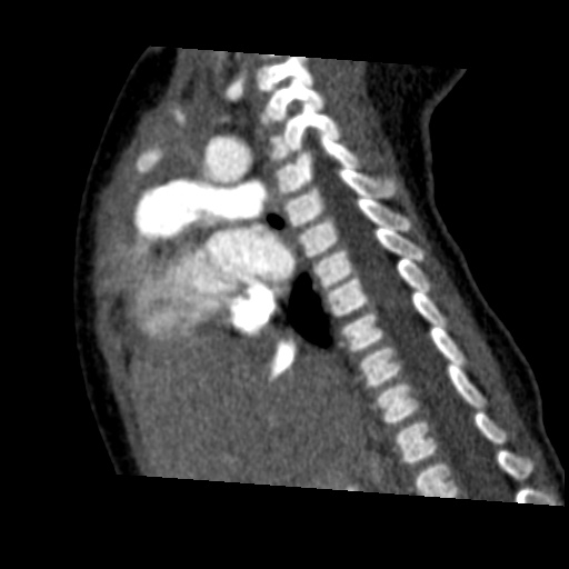 File:Aberrant left pulmonary artery (pulmonary sling) (Radiopaedia 42323-45435 Sagittal C+ arterial phase 26).jpg