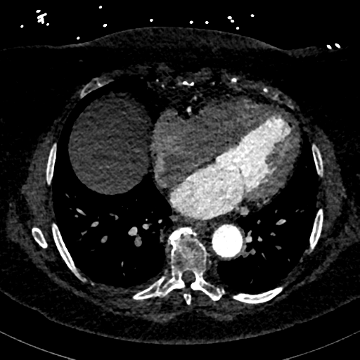 File:Aberrant right subclavian artery with Kommerell diverticulum (Radiopaedia 47982-52769 Axial C+ arterial phase 64).png