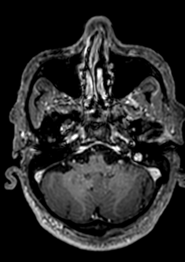 Accessory middle cerebral artery (Radiopaedia 73114-83828 Axial T1 C+ 142).jpg