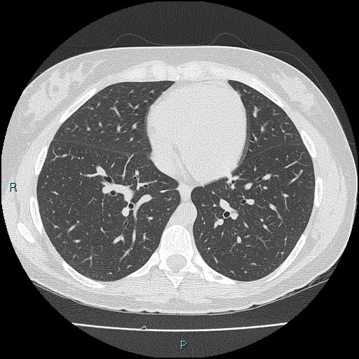 Accidental foreign body aspiration (seamstress needle) (Radiopaedia 77740-89983 Axial lung window 42).jpg