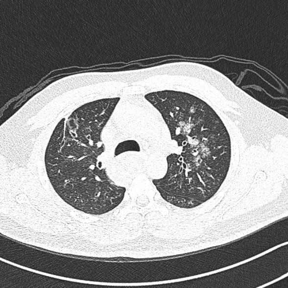 Achalasia with aspiration (Radiopaedia 55413-61845 Axial lung window 23).jpg