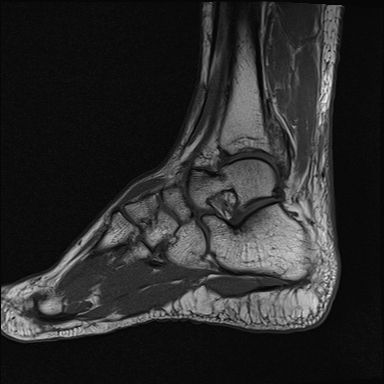 File:Achilles tendon tear (Radiopaedia 77615-89819 Sagittal T1 14).jpg