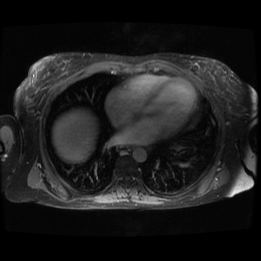 Acinar cell carcinoma of the pancreas (Radiopaedia 75442-86668 Axial T1 C+ fat sat 143).jpg