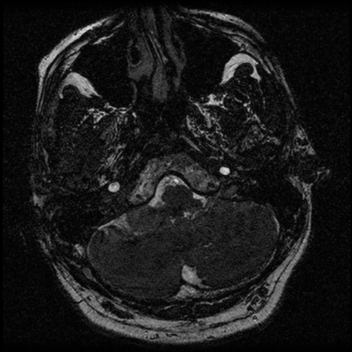 File:Acoustic schwannoma (Radiopaedia 39170-41387 Axial FIESTA 36).png
