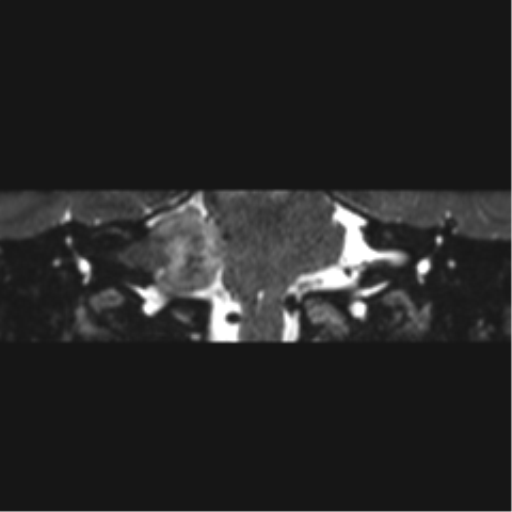 File:Acoustic schwannoma (Radiopaedia 50846-56358 Coronal T2 22).png