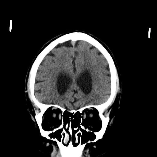 File:Acoustic schwannoma (Radiopaedia 55729-62280 Coronal non-contrast 12).png
