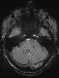 Acoustic schwannoma (Radiopaedia 55729-62281 Axial SWI 12).png