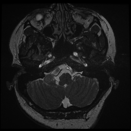Acoustic schwannoma (Radiopaedia 57574-64536 Axial T2 12).png