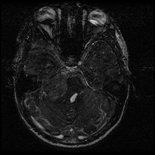 Acoustic schwannoma - eroding petrous apex (Radiopaedia 39674-42004 Axial T2 62).png