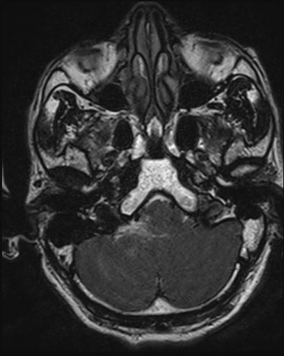 File:Acoustic schwannoma - probable (Radiopaedia 20386-20292 Axial T1 27).jpg