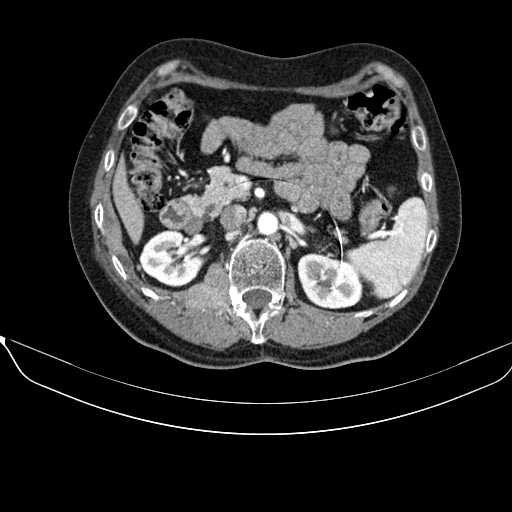 File:Acquired adrenal hyperplasia - due to thymic carcinoid tumor (Radiopaedia 21269-21184 C+ arterial phase 45).jpg